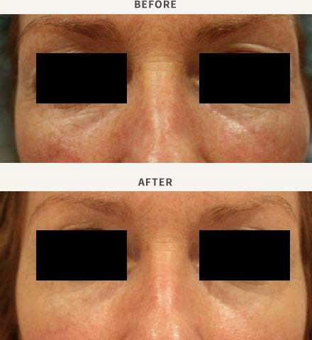 ERBIUM LASER RESURFACING - PERIORBITAL