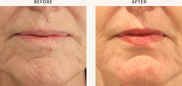 ERBIUM LASER RESURFACING - PERIORAL