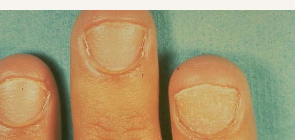 NAIL DISORDERS - PSORIASIS