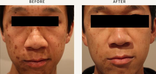 REVLITE LASER - ACNE SCARS