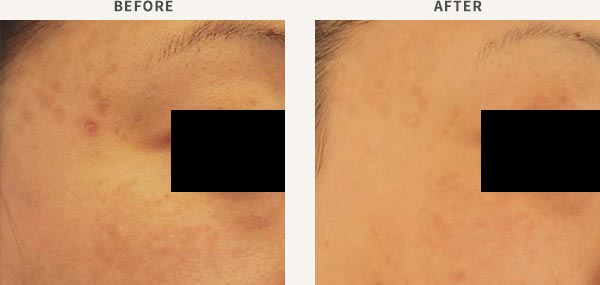 REVLITE LASER - MELASMA