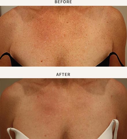 BROADBAND LIGHT PHOTO-REJUVENATION