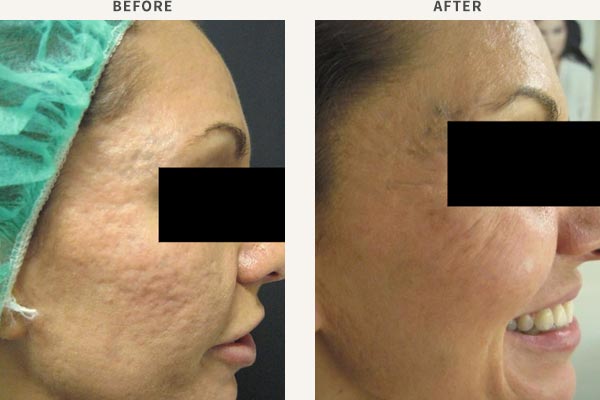 FRACTIONAL LASER RESURFACING - ACNE SCAR