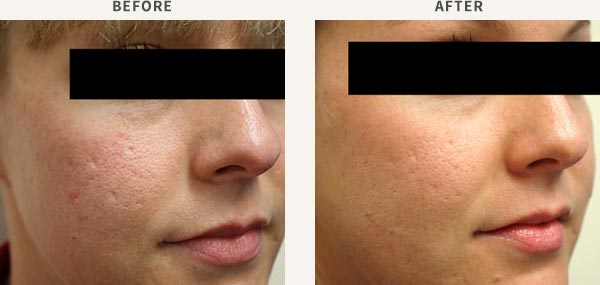 FRACTIONAL LASER RESURFACING - ACNE SCAR