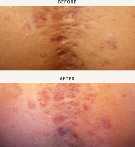 FRACTIONAL LASER RESURFACING - ACNE SCAR