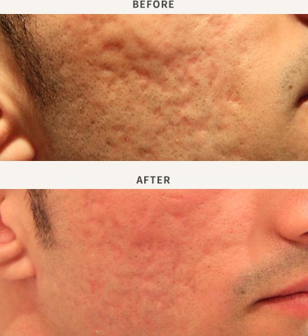 FRACTIONAL LASER RESURFACING - ACNE SCAR