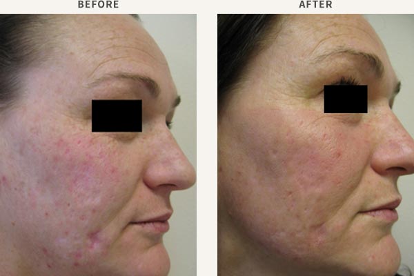 FRACTIONAL LASER RESURFACING - ACNE SCAR