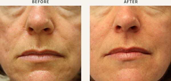 INFRARED SKIN TIGHTENING & DERMAL FILLERS - ACNE SCAR