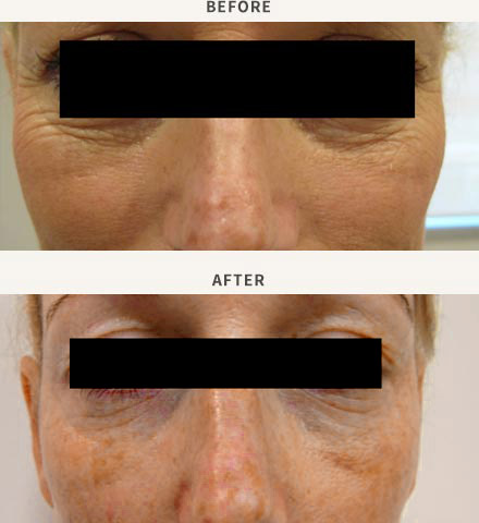 ERBIUM LASER RESURFACING - PERIORBITAL