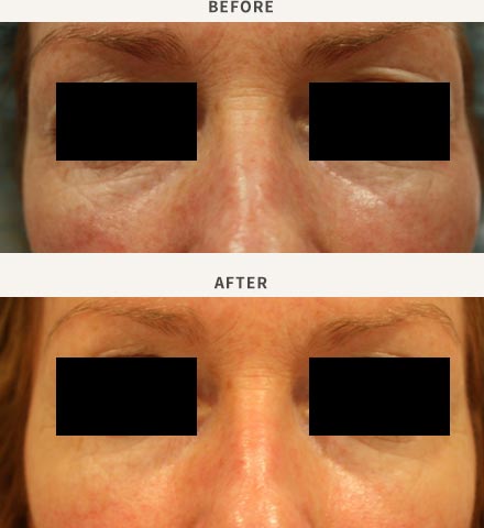 ERBIUM LASER RESURFACING - PERIORBITAL