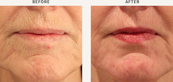 ERBIUM LASER RESURFACING - PERIORBITAL