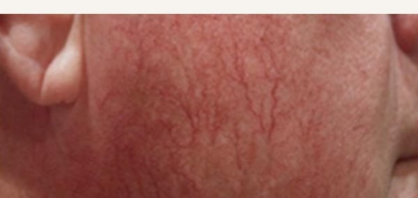 ROSACEA