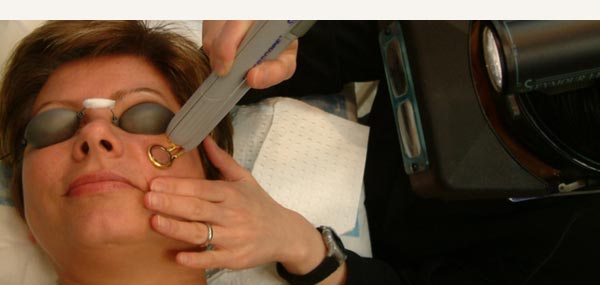 LASERSCOPE VASCULAR LASER - ROSACEA