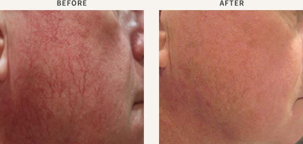 LASERSCOPE VASCULAR LASER - FACIAL CAPILLARIES