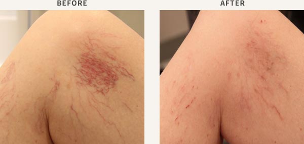 LASERSCOPE VASCULAR LASER - LEG VEINS