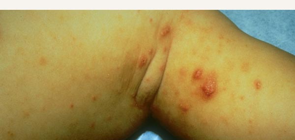 SCABIES