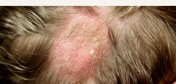 TINEA INFECTION