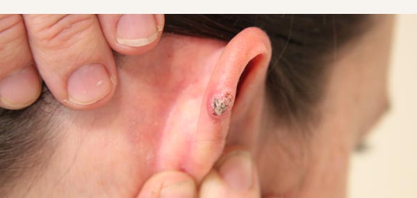 SQUAMOUS CELL CARCINOMA