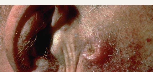 SQUAMOUS CELL CARCINOMA