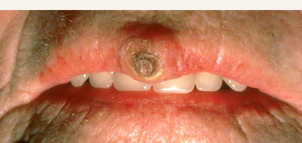 SQUAMOUS CELL CARCINOMA