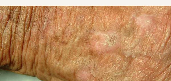 ACTINIC KERATOSES