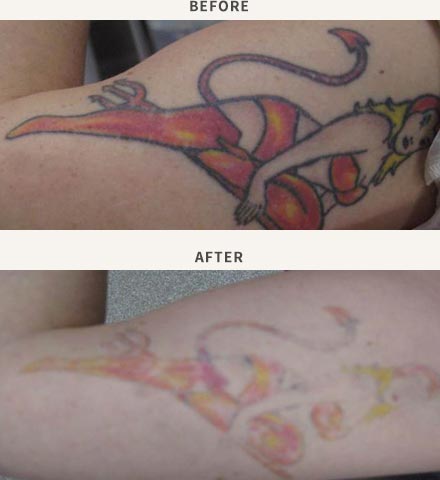 REVLITE LASER - TATTOO REMOVAL