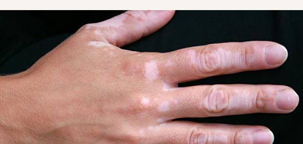 VITILIGO