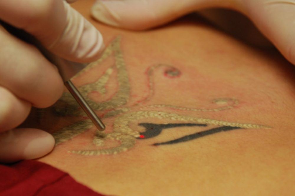 factsabouttattooremoval