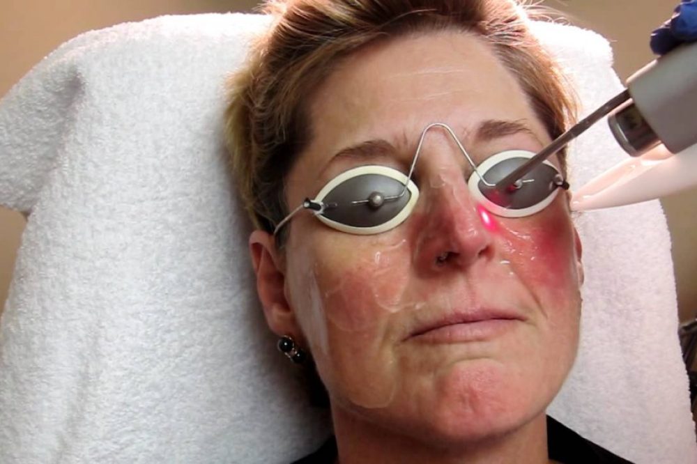 howtotreatrosacea-part2-1024x576